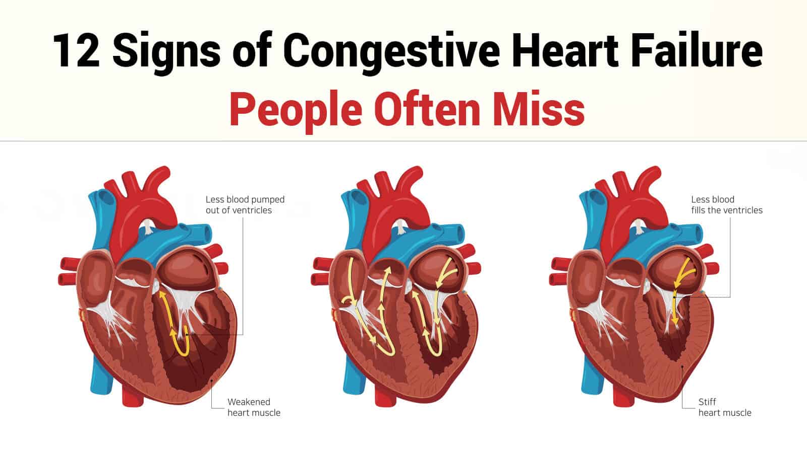 12 Signs of Congestive Heart Failure People Often Miss
