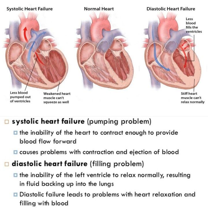 43 best Diastolic Heart Failure images on Pinterest