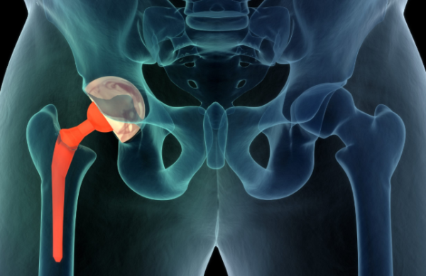 8 Reasons for Hip Replacement Failure