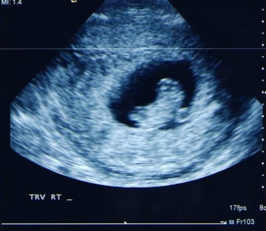 8 week ultrasound pictures, please? :)