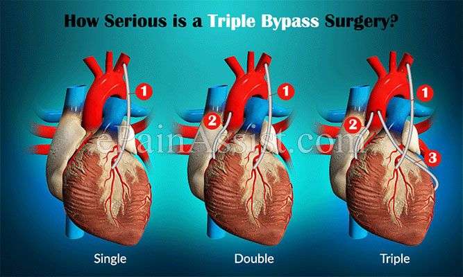 A triple bypass surgery is an open heart surgery, and it ...