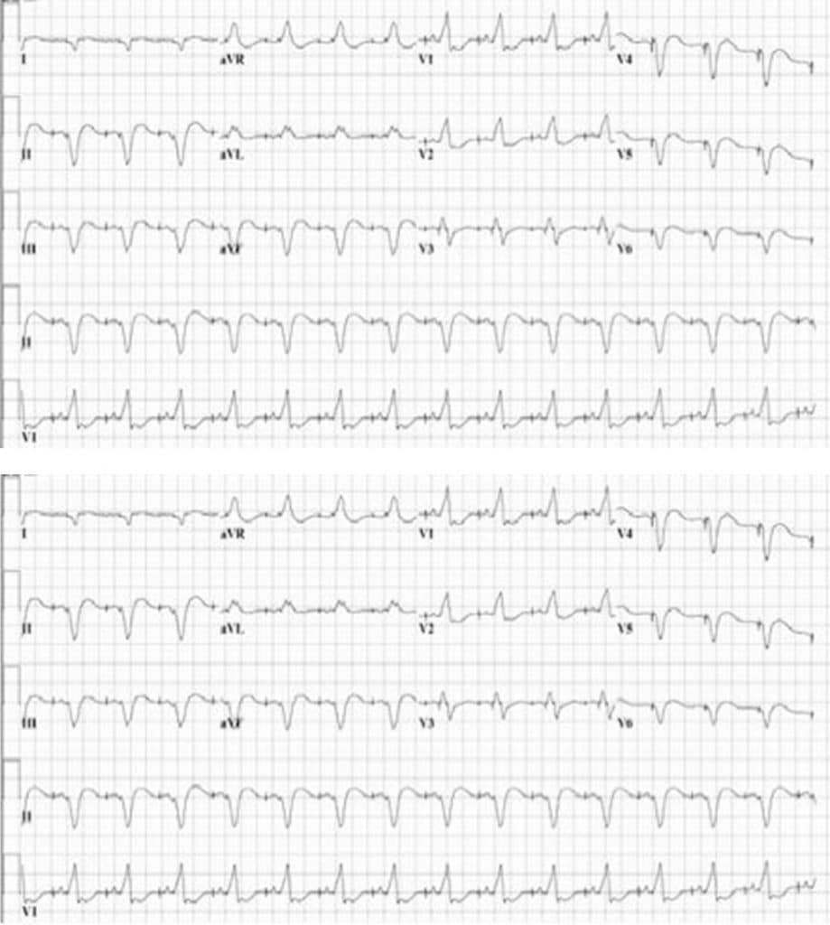 Acute Heart Failure Exacerbation in the Setting of Electrical Storm ...