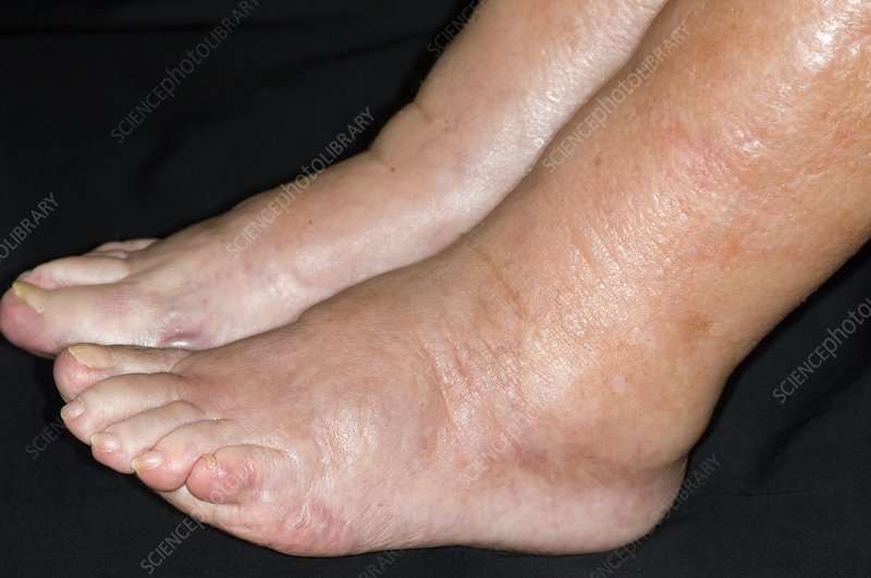 Ankle oedema in heart failure