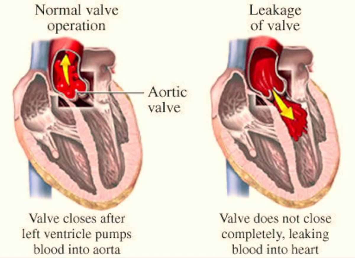 Aortic Valve Regurgitation