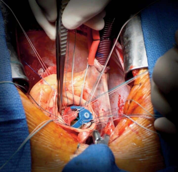Aortic valve replacement