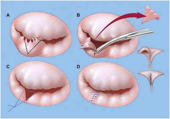 Aortic Valve Replacement Surgery and Replacement at India Surgery Tour