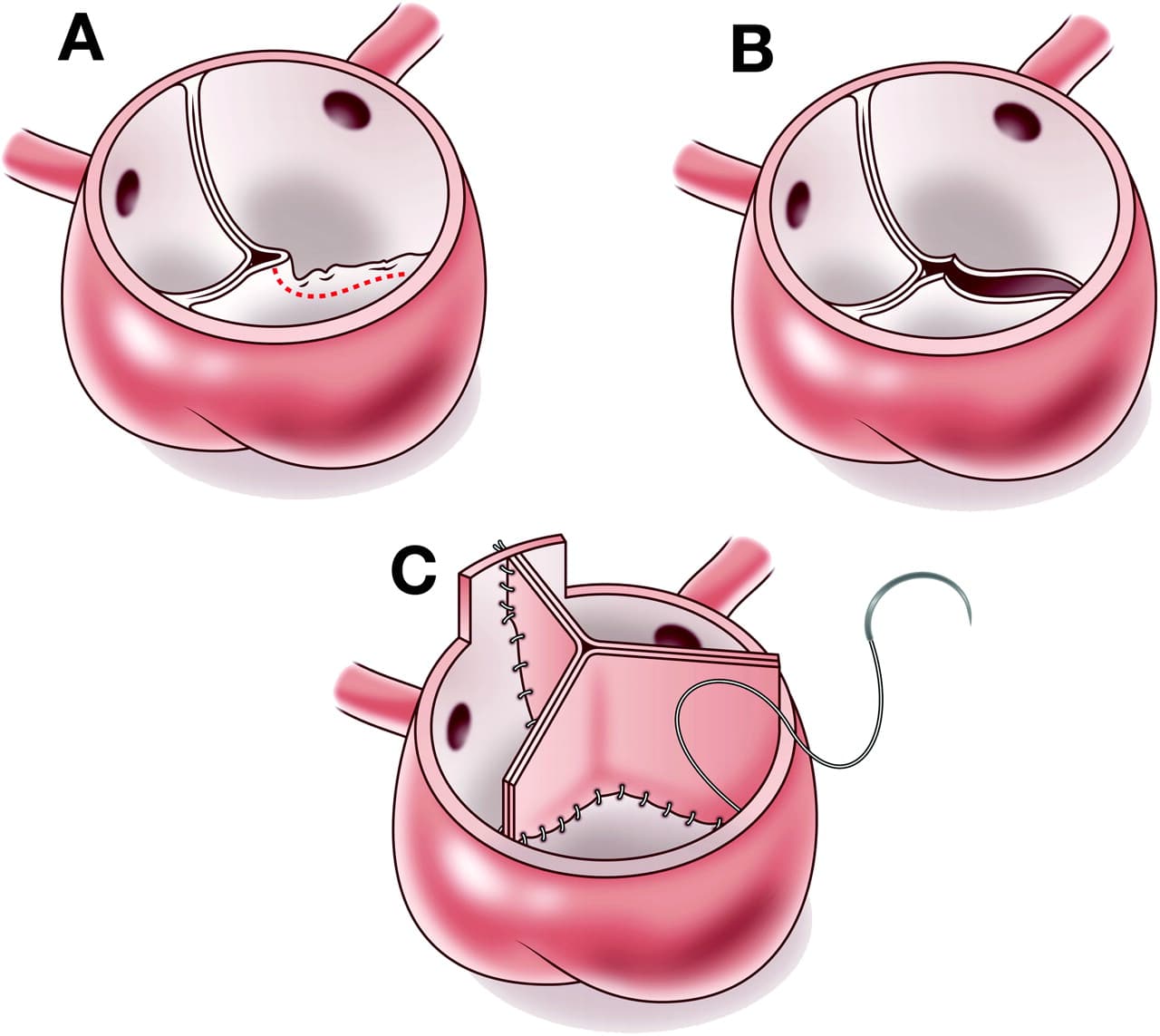 Aortic valve surgery in children