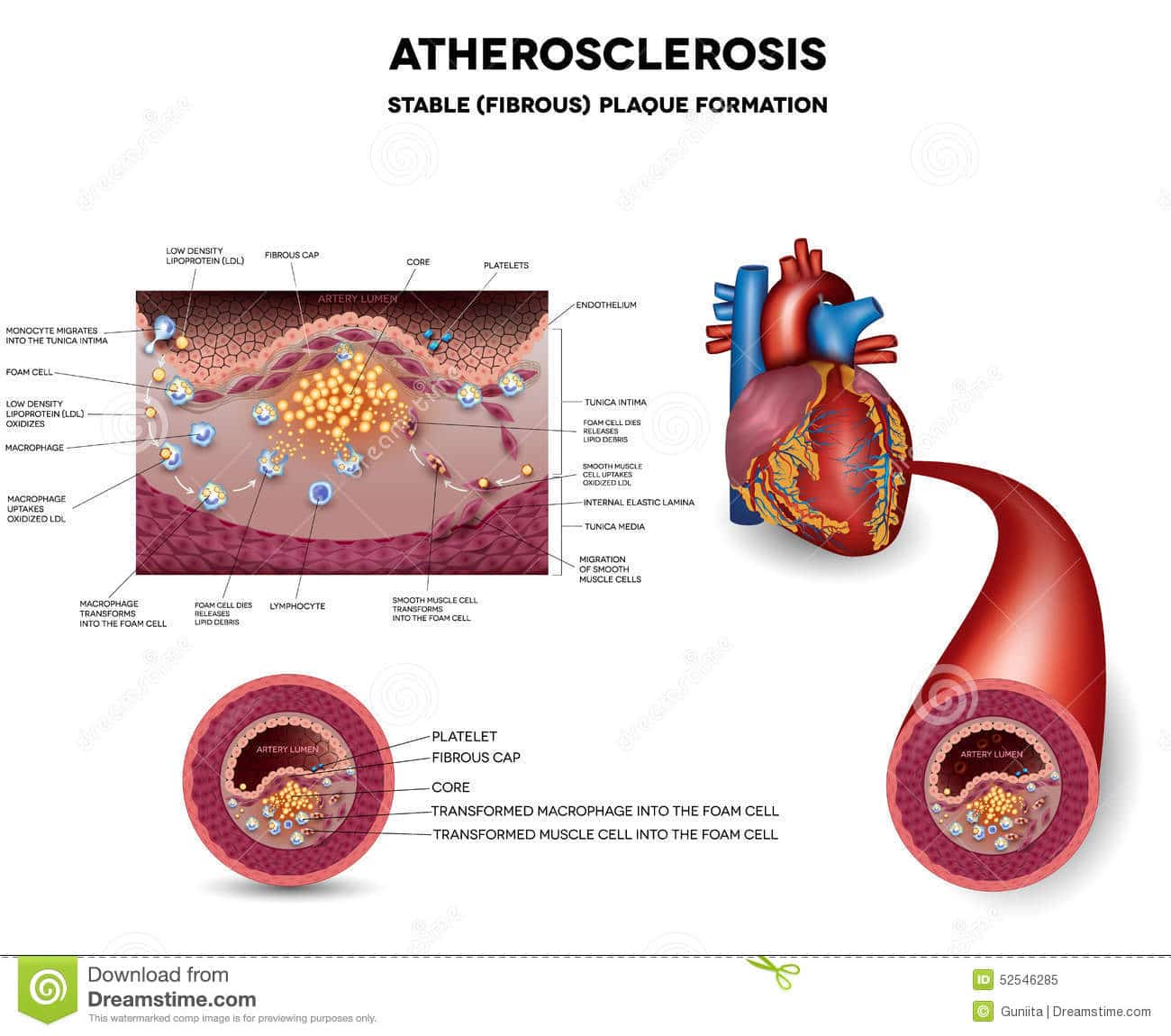 Atherosclerosis. Fibrous Plaque Formation Stock Vector