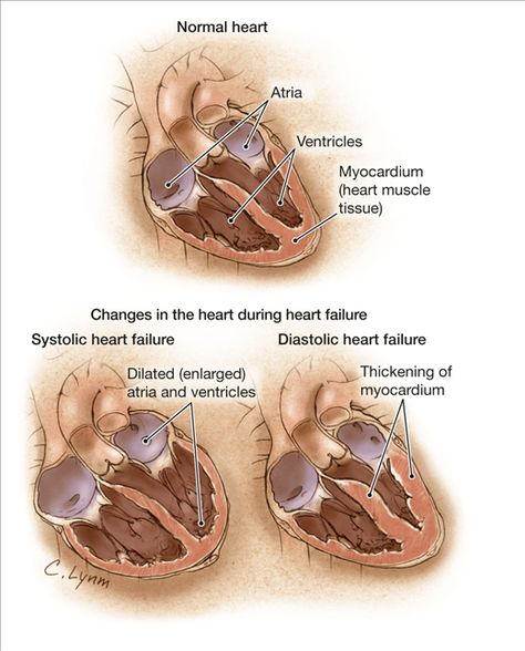 Best 25+ Systolic heart failure ideas on Pinterest
