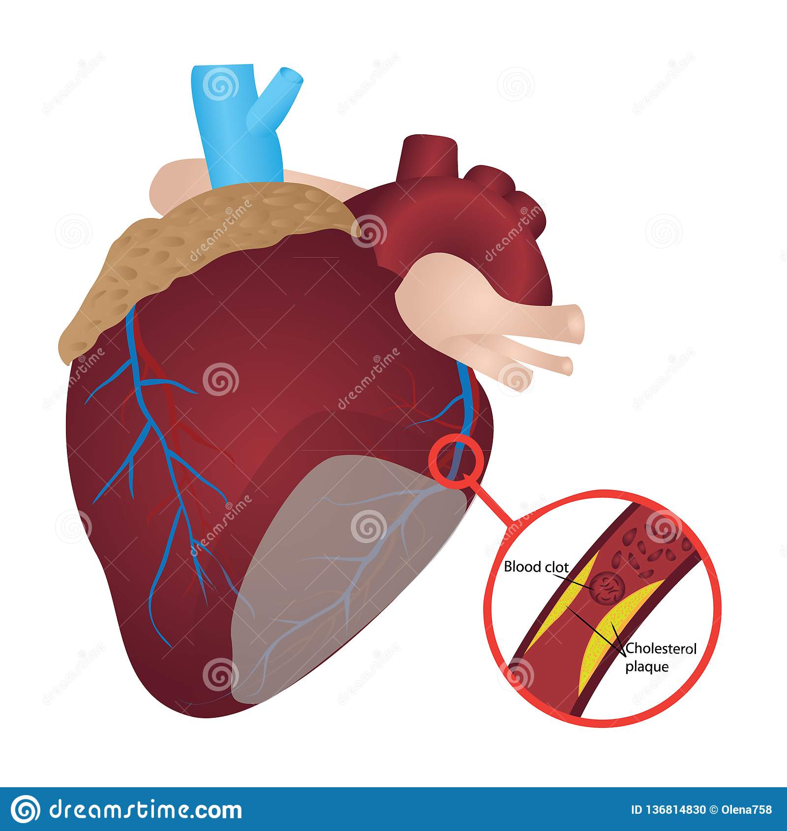 Blood Clot Cholesterol Plaque I Heart Attack Stock Vector ...