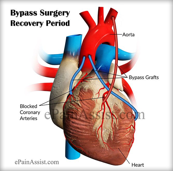 Bypass surgery recovery period depends on individuals prior health ...