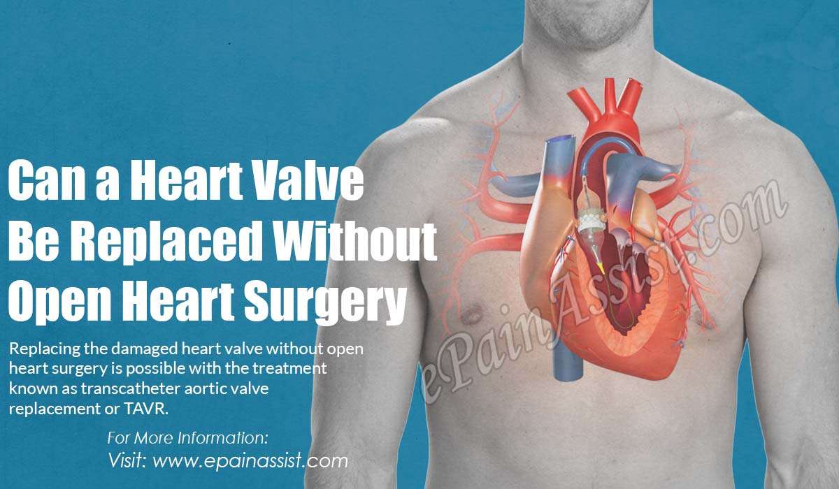Can a Heart Valve Be Replaced Without Open Heart Surgery?