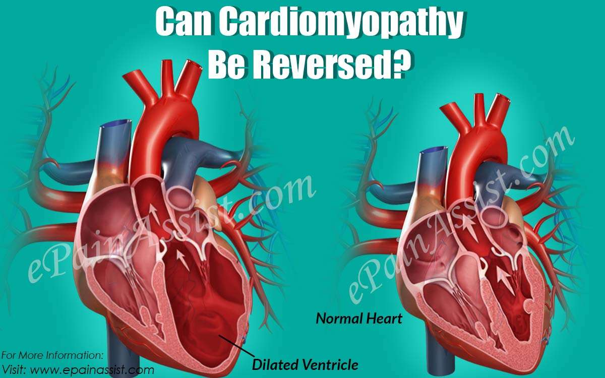 Can Cardiomyopathy Be Reversed?