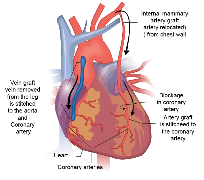 Can Surgery Be Used to Treat Heart Failure