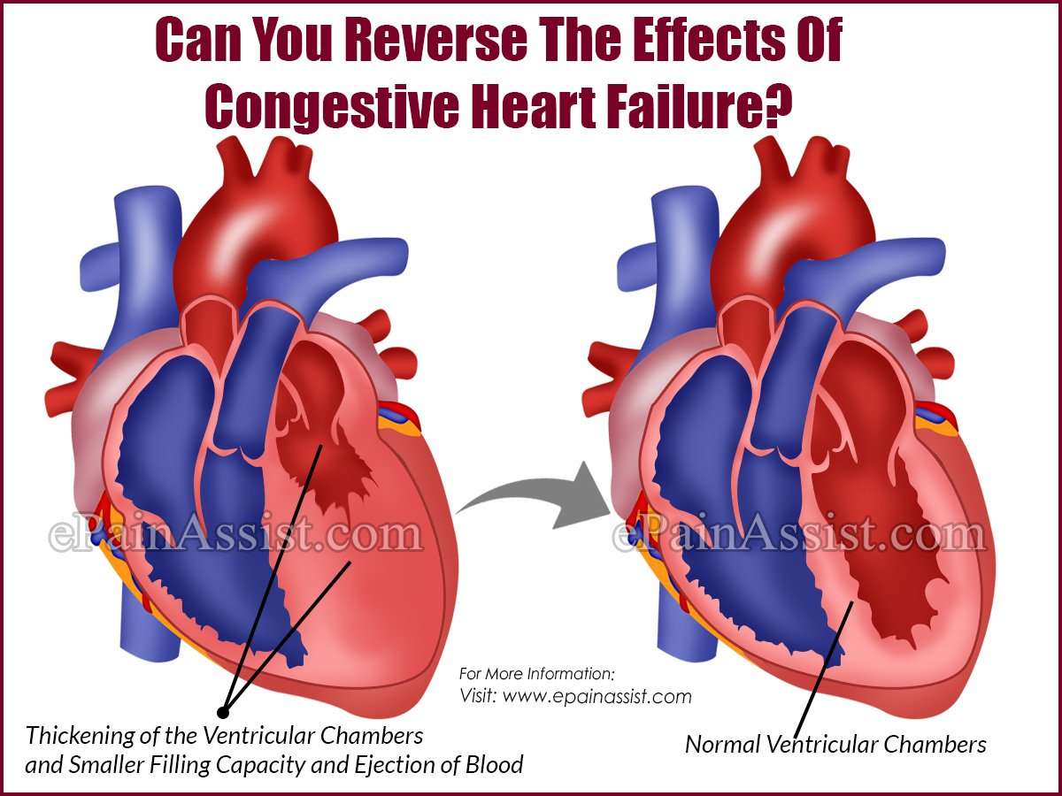 Can You Reverse The Effects Of Congestive Heart Failure?