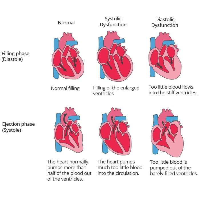 Cardiac insufficiency  heart failure