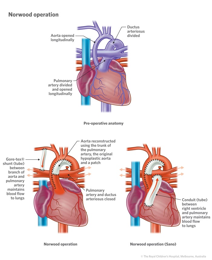 Cardiology : Hypoplastic Left Heart Syndrome HD