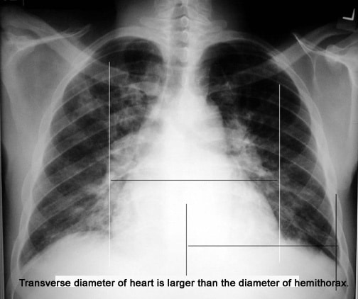 Cardiomegaly:
