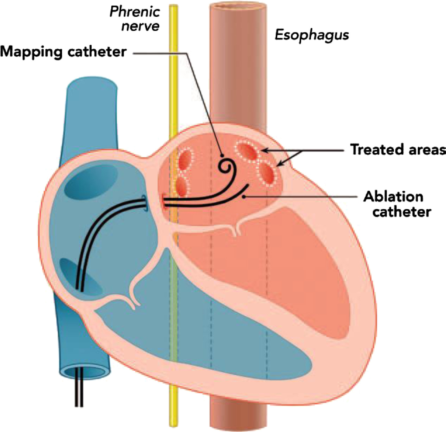 Catheter Ablation for Atrial Fibrillation