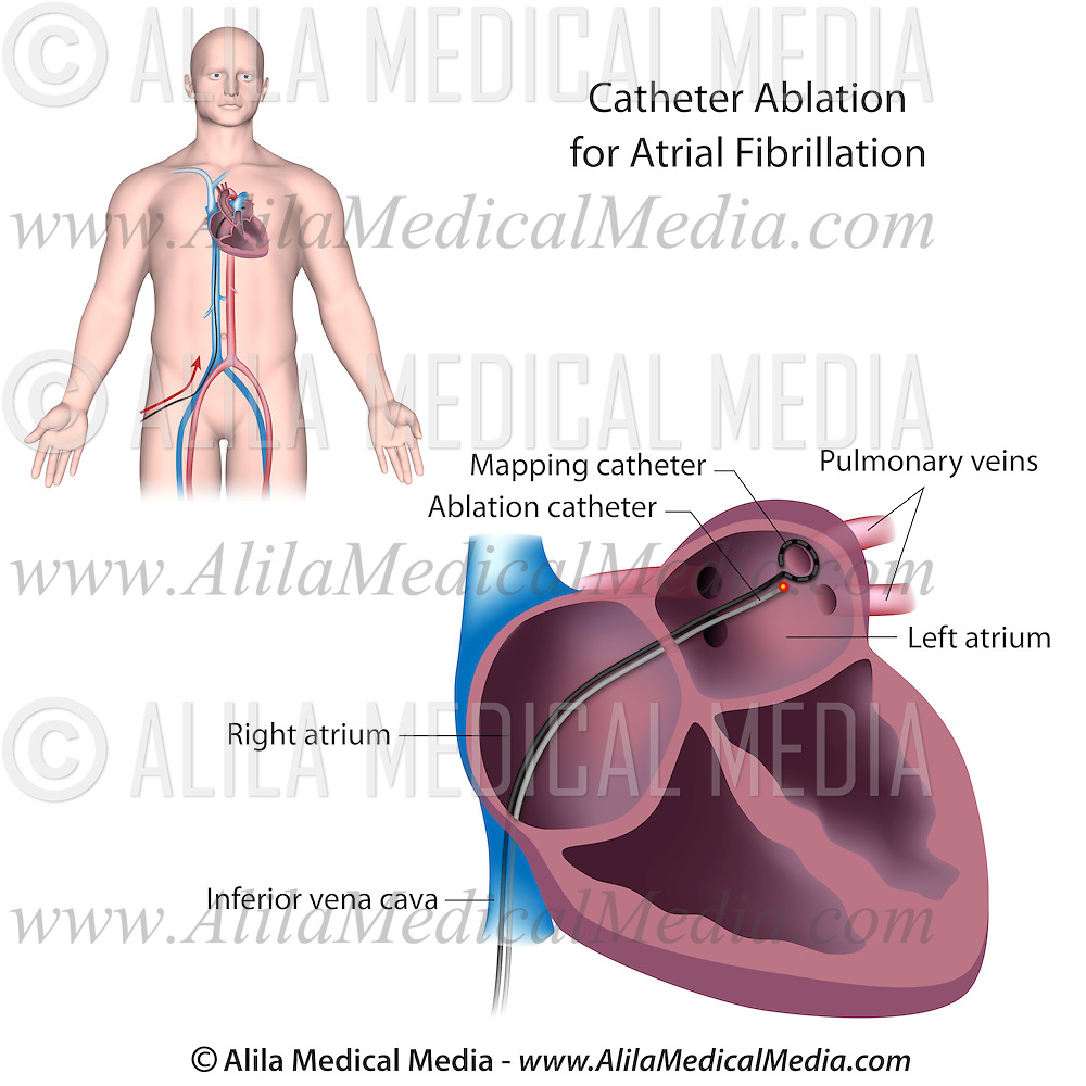 Catheter ablation procedure for atrial fibrillation