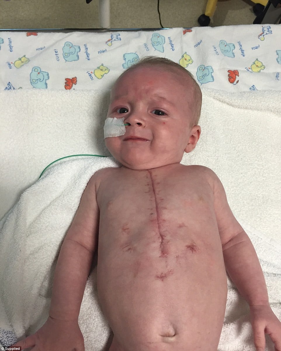 CHD babies in Australia show scars from surgery