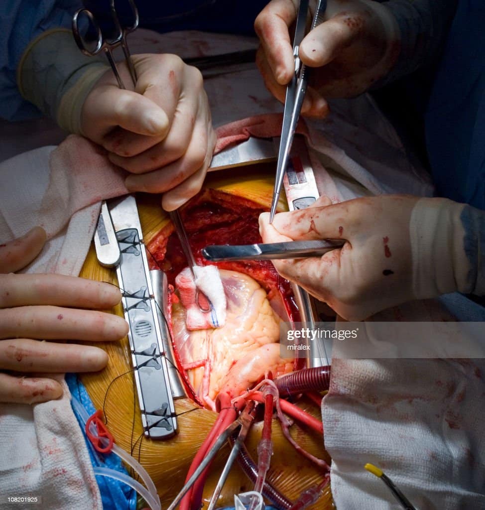 Cirurgia De Bypass Cardíaco Foto de stock