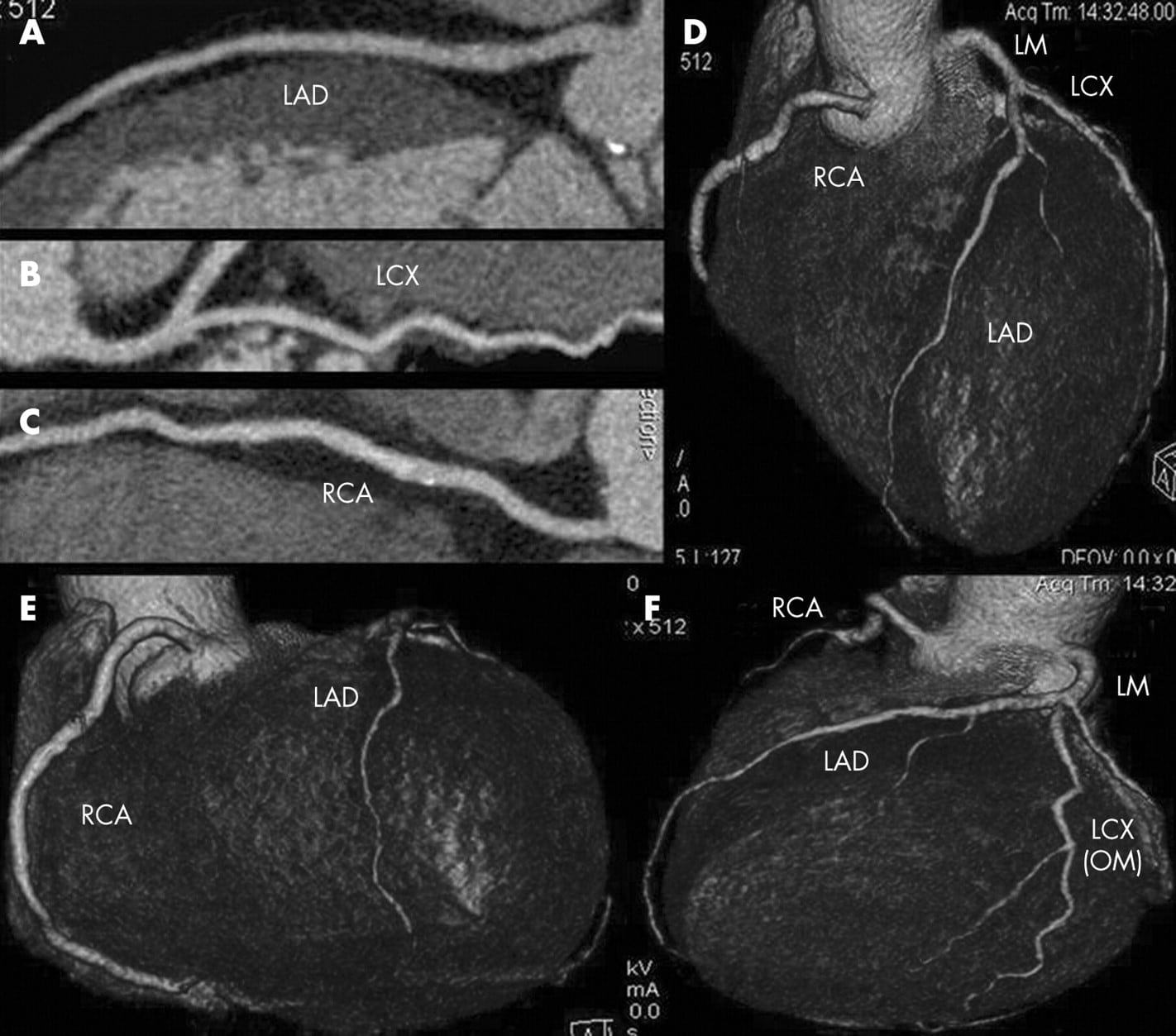 Clinical value of multidetector CT coronary angiography as a ...