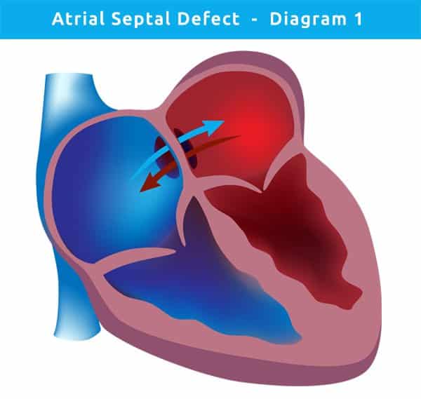 Closure of Atrial Septal Defect