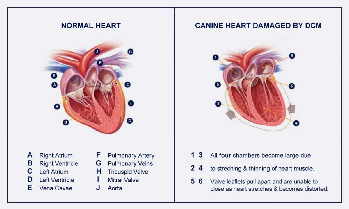 Congestive Heart Failure (CHF) As A Result Of Dilated Cardiomyopathy ...