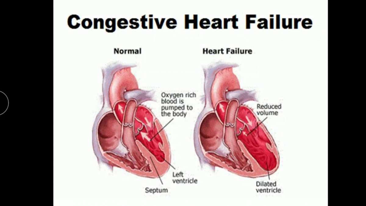 Congestive Heart failure