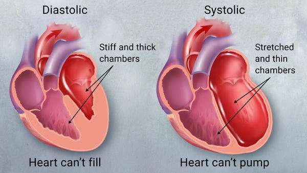 Congestive Heart Failure Explained  Central Georgia Heart ...