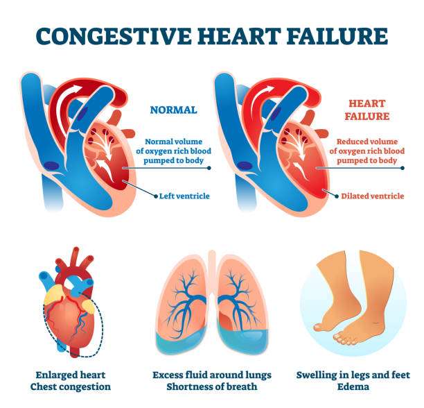 Congestive Heart Failure Illustrations, Royalty