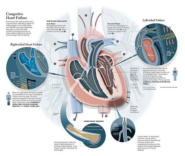 Congestive Heart Failure infograph CLICK to enlarge picture for better ...