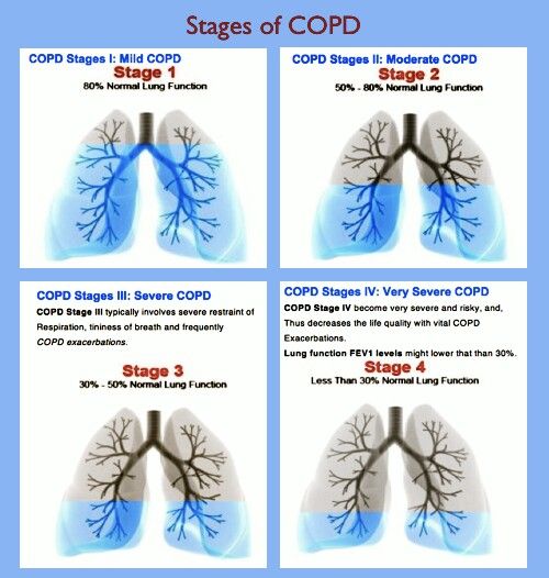 COPD stages. If you or a loved one needs help with COPD, check out ...