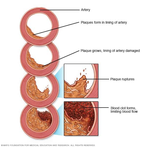 Coronary angioplasty and stents
