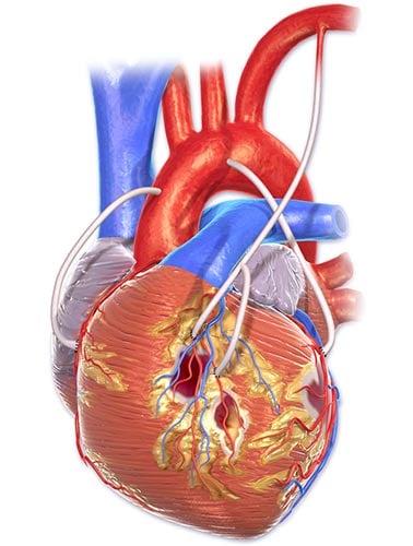 Coronary Artery Bypass Graft Surgery (CABG)