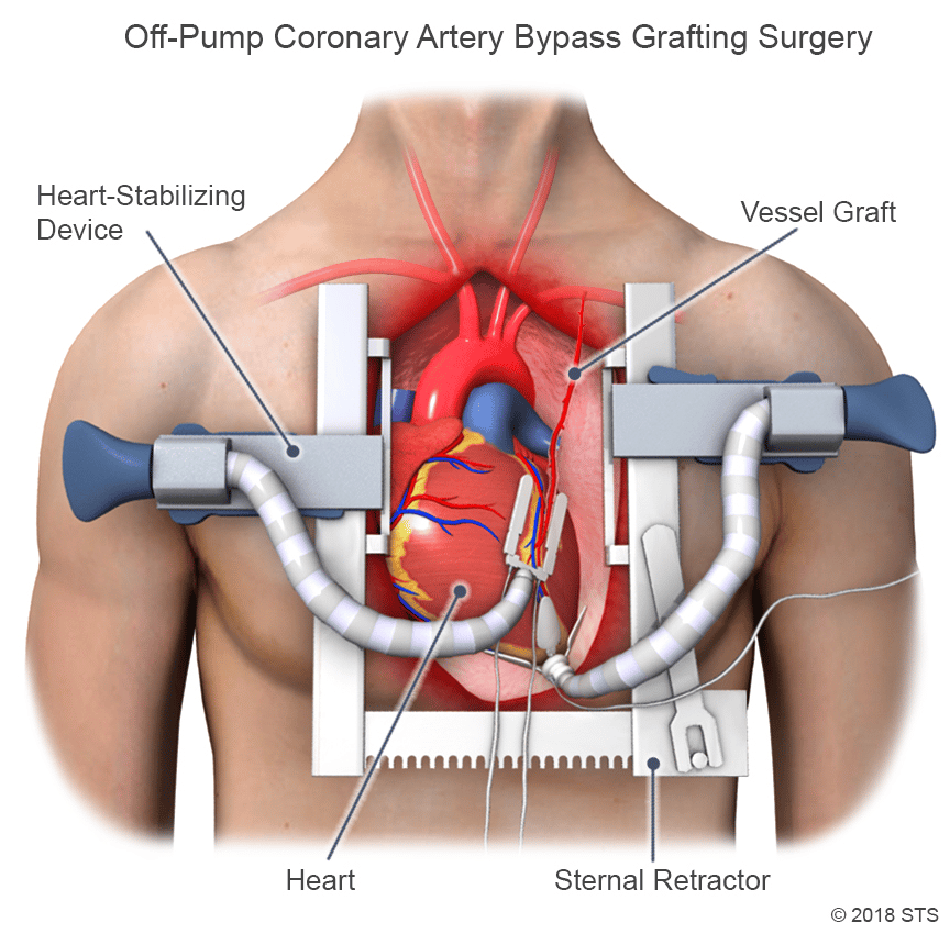 Coronary Artery Bypass Grafting (CABG)