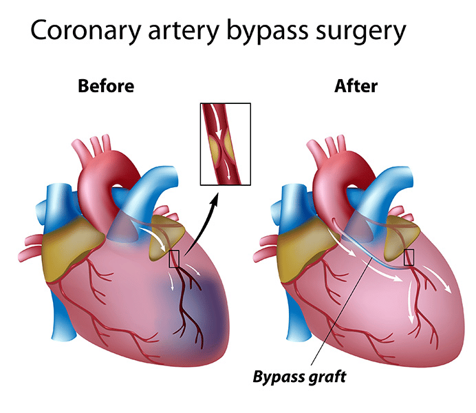 Coronary artery bypass surgery on emaze