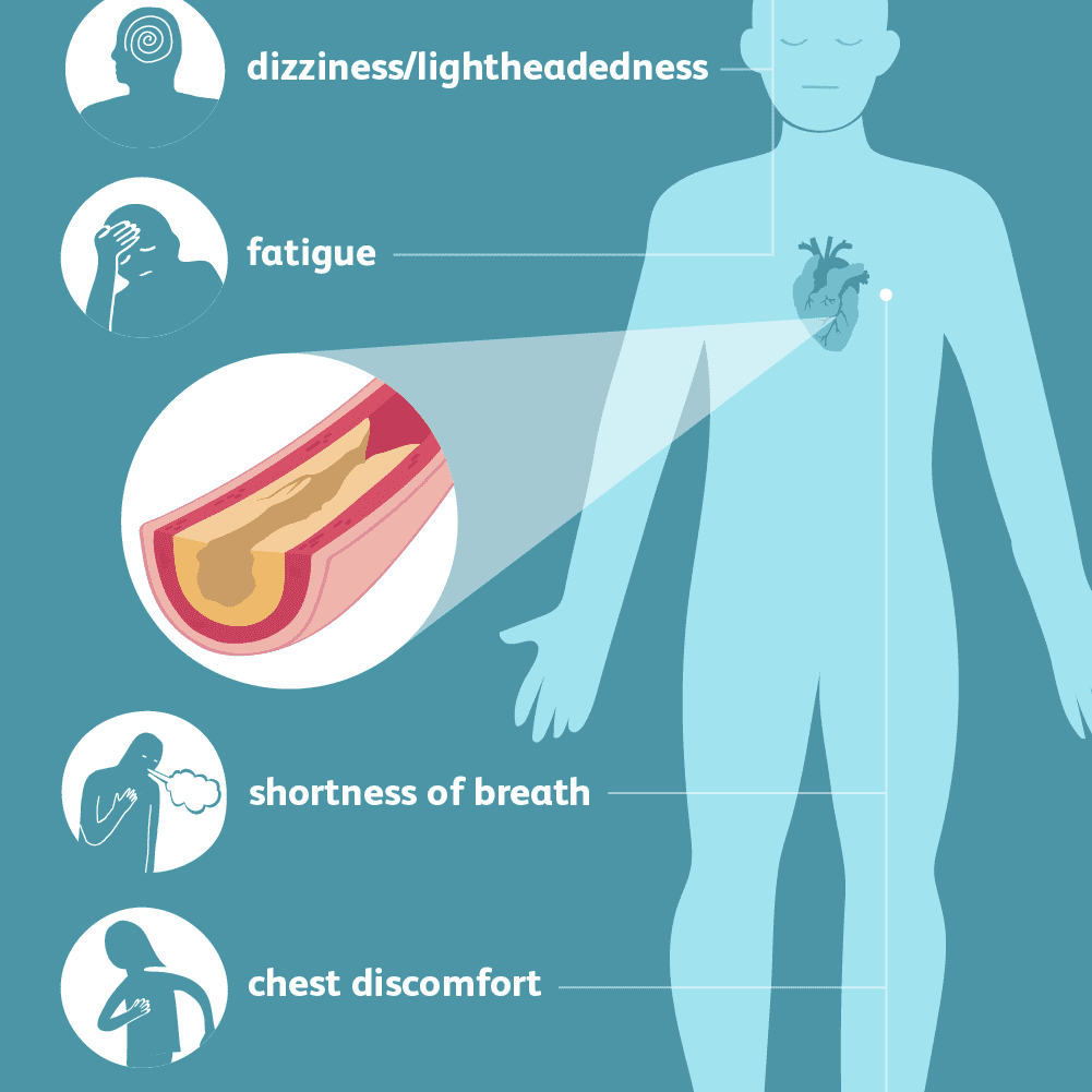 Coronary Artery Disease: Signs, Symptoms, and Complications