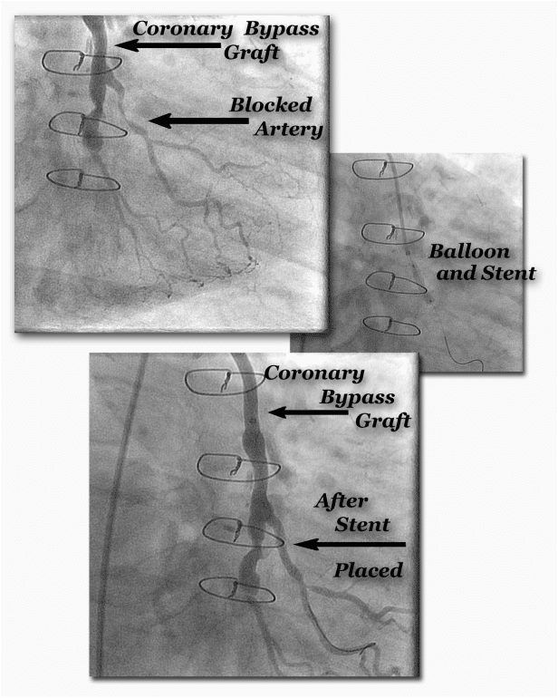 Coronary Stent Procedure in a Patient with Bypass Surgery 22 Years Ago