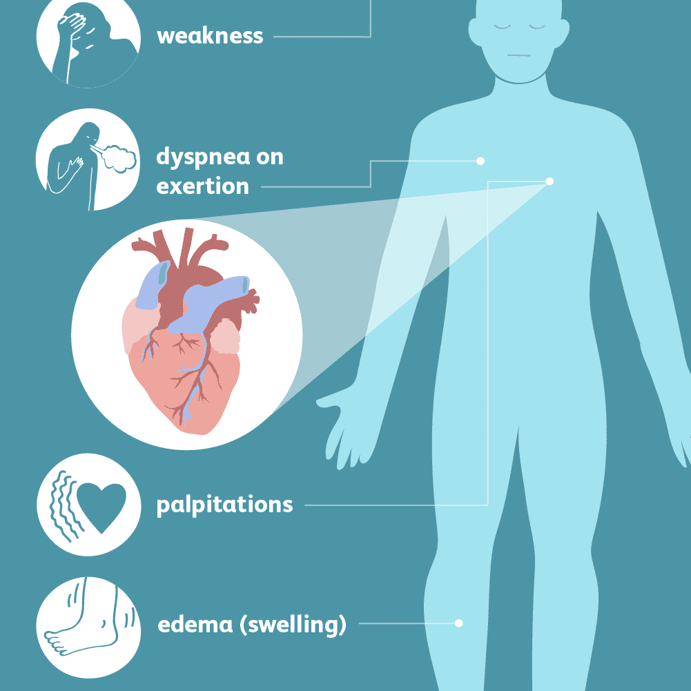 Coughing and Heart Failure: Cardiac Cough Explained