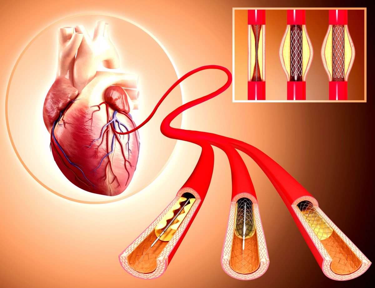 Do Angioplasty and Stents Increase Life Expectancy?