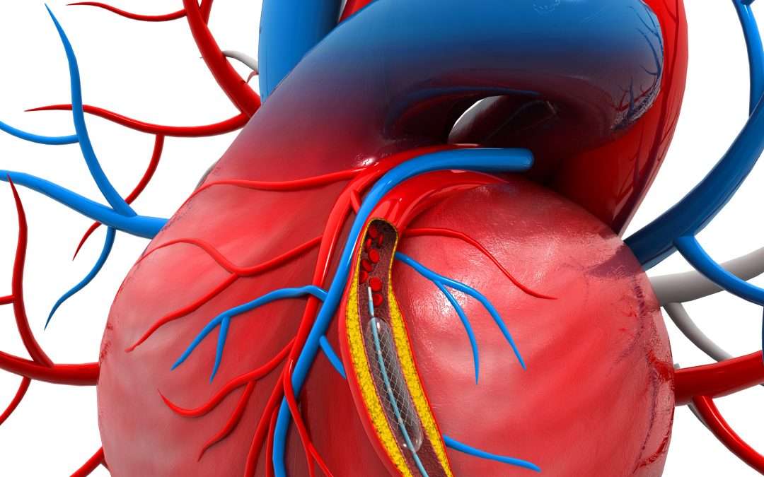 Do You Need a Cardiac Angioplasty?