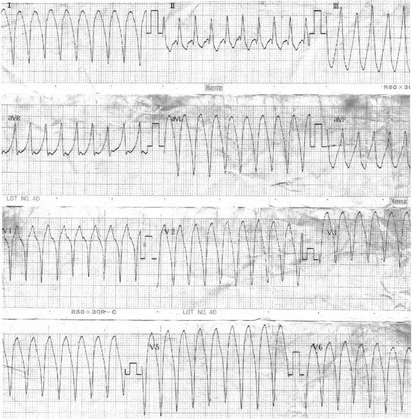 ECG: ventricular tachycardia with a heart rate of 200 bpm ...