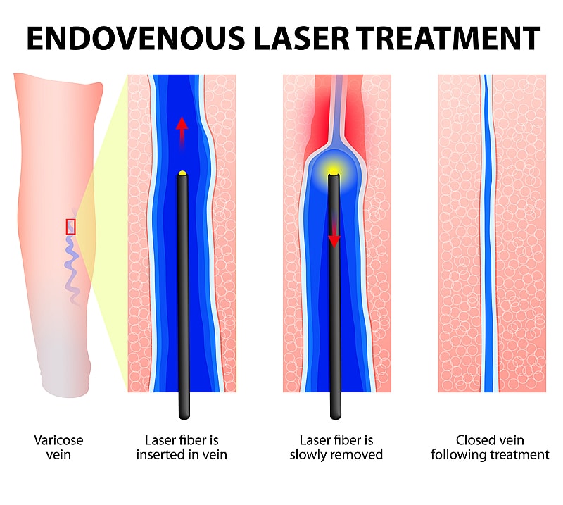 Endovenous Laser Therapy : Carolina Heart and Leg Center
