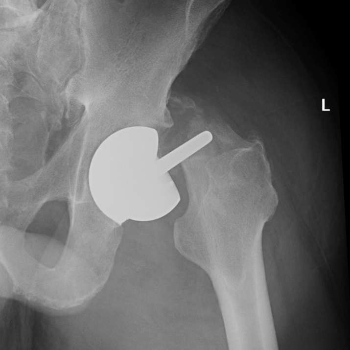 Failure Mechanisms in Hip Resurfacing Arthroplasty
