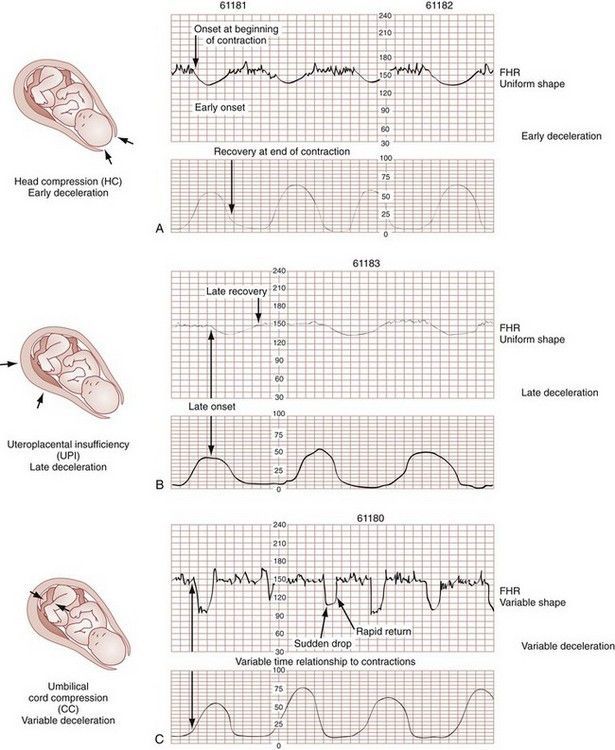 fetal heart rate monitor interpretation