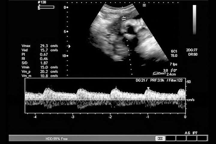 Fetal Heartbeat: Week