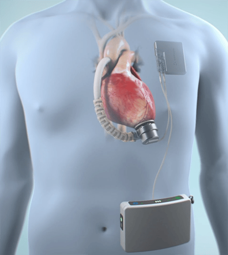Fully Implantable LVAD for End