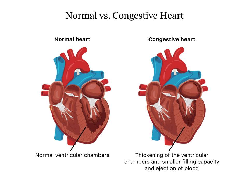 Get Congestive Heart Failure Kidney Failure Diabetes You Must Know ...